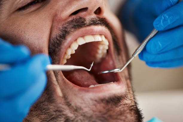 Best Emergency Dentist for Lost Fillings or Crowns in Bell Nyon, CA